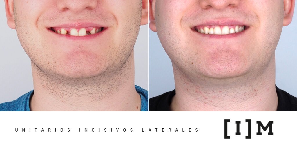 IMPLANTES-UNITARIOS_I9MPLANTOLOGIA MADRID