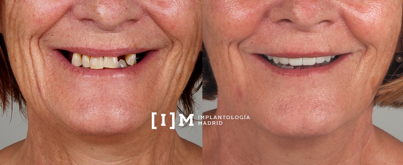 implantes-dentales-madrid