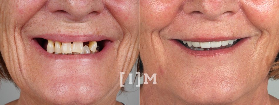 protesis-hibrida-implantes-dentales-madrid