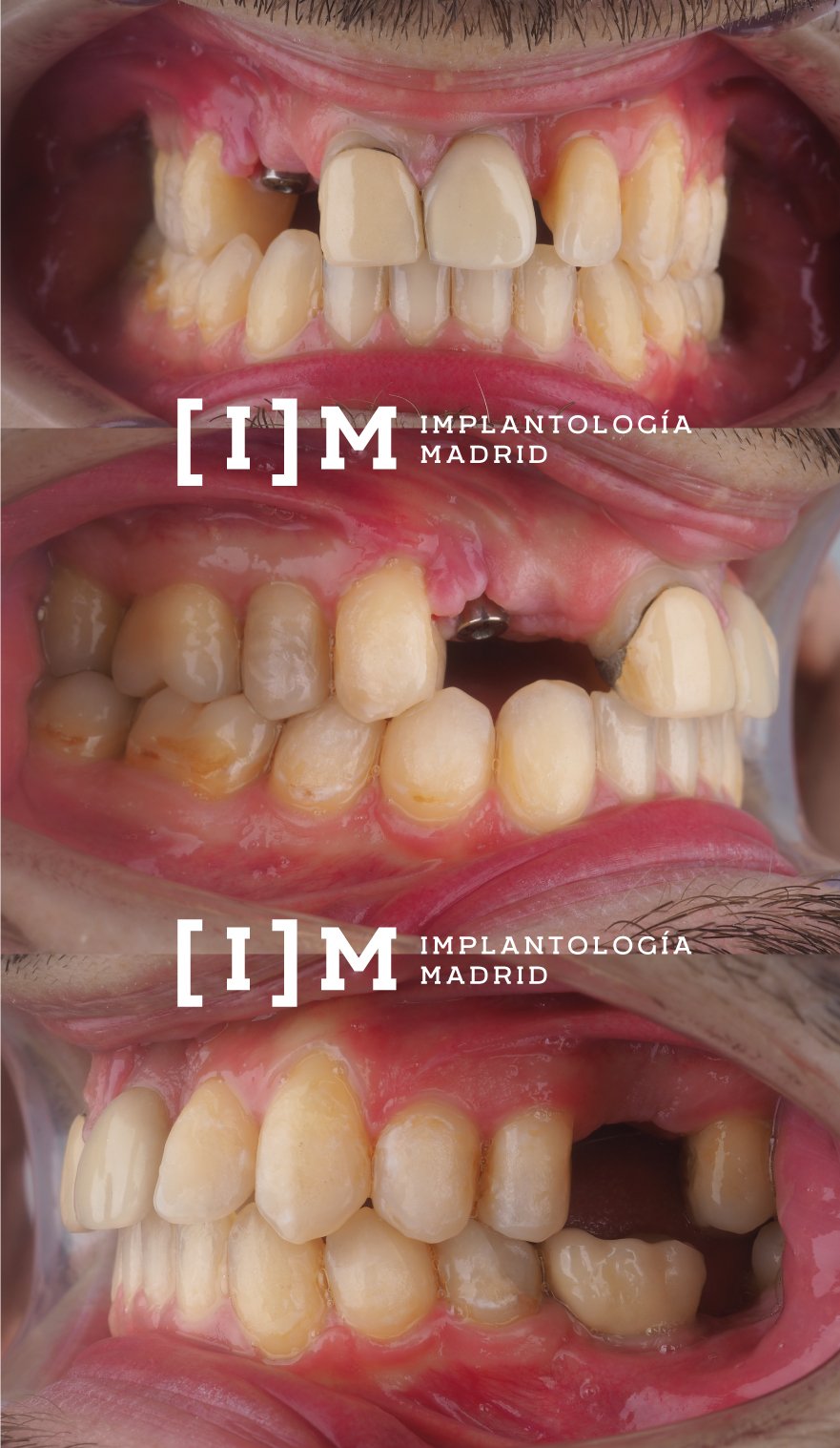 caso de implantes dentales en madrid