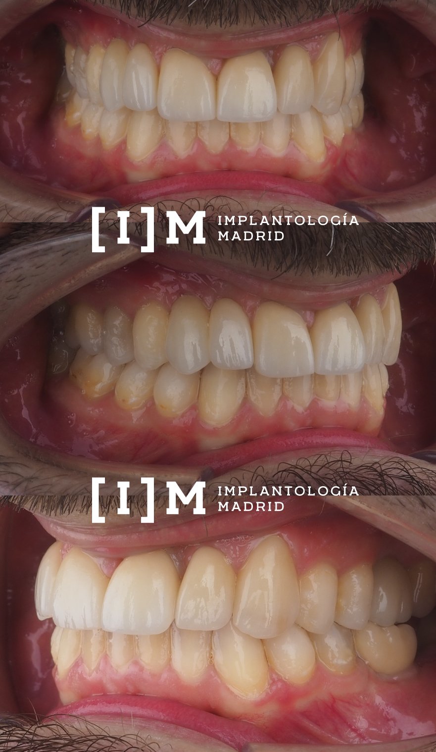 caso terminado de implantes dentales en madrid