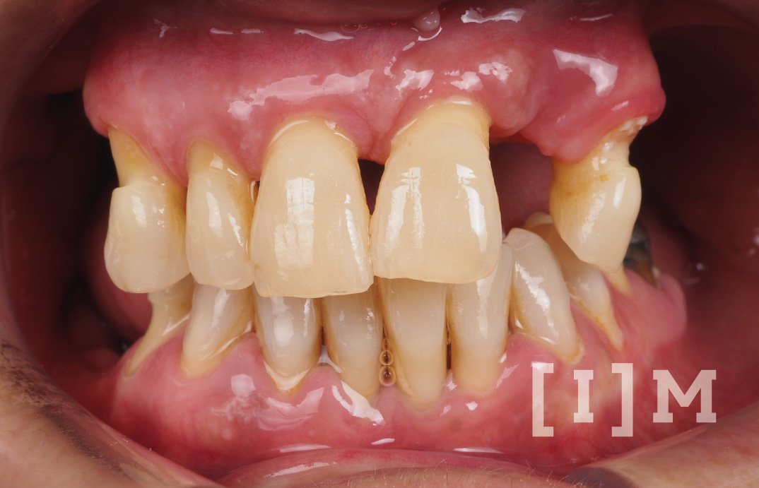 rehabilitacion-implantes-dentales-madrid