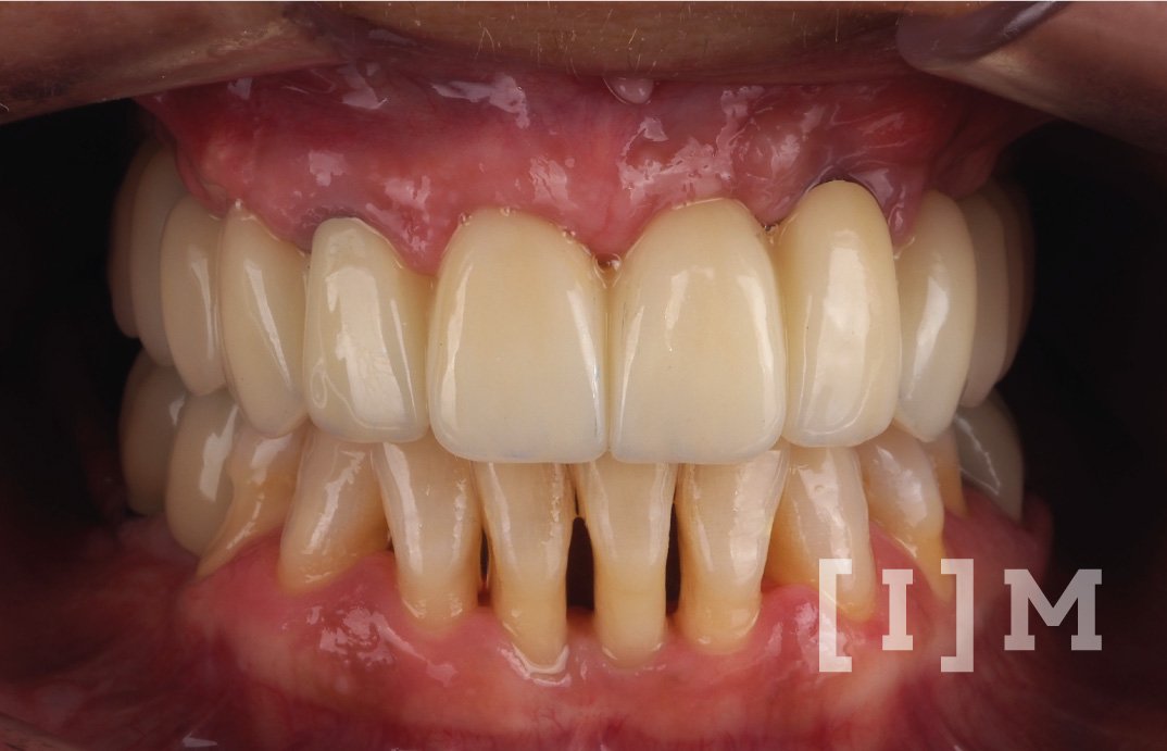 rehabilitacion-implantes-dentales-madrid