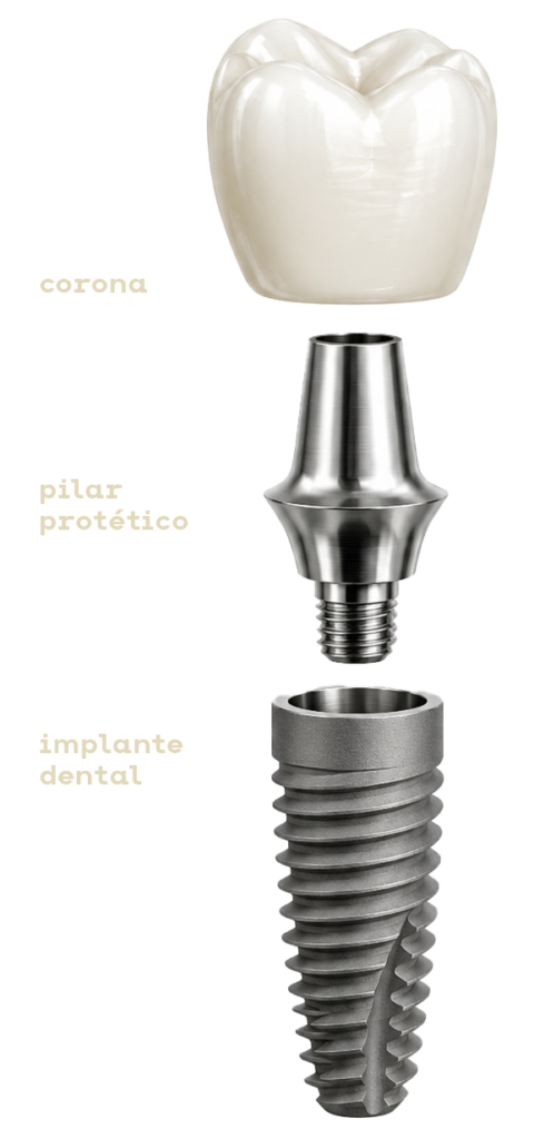 partes-implante-dental-