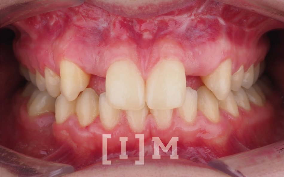 Implantes_dentales_madrid