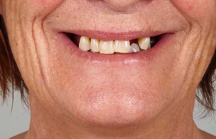 rehabilitacion-IMPLANTES-DENTALES