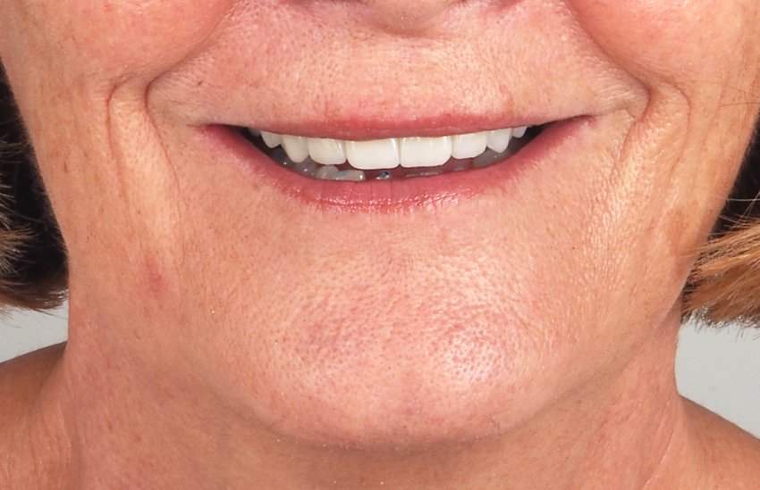 rehabilitacion-implantes-dentales
