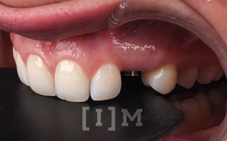 implante-dental-unitario-madrid